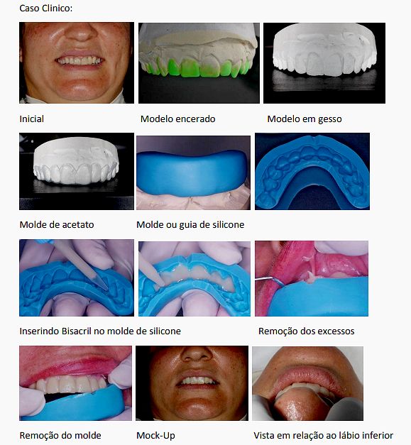 Estudo para o planejamento dos dentes no tratamento estético com lentes de contato dental, facetas de porcelana ou coroas de porcelana. Pdf Mock Up Como Ferramenta De Marketing Prof Paulo Tomio Minami